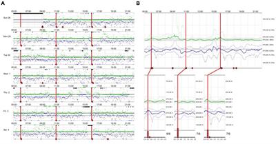 Identification and quantitative assessment of motor complications in Parkinson’s disease using the Parkinson’s KinetiGraph™